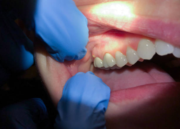 Best Emergency Cosmetic Dentistry (e.g., broken veneers) in Hellertown, PA